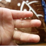 指の皮がむける病気がある？原因と治し方とは？